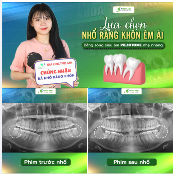 RĂNG KHÔN MỌC LỆCH XA VÀ CÁCH XỬ LÝ