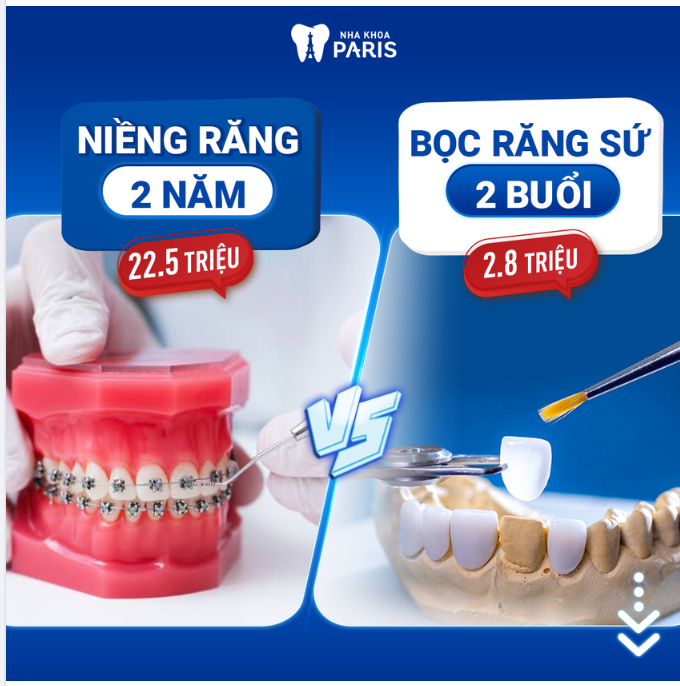 Răng ố vàng, khấp khểnh nhẹ - Ngại niềng răng?