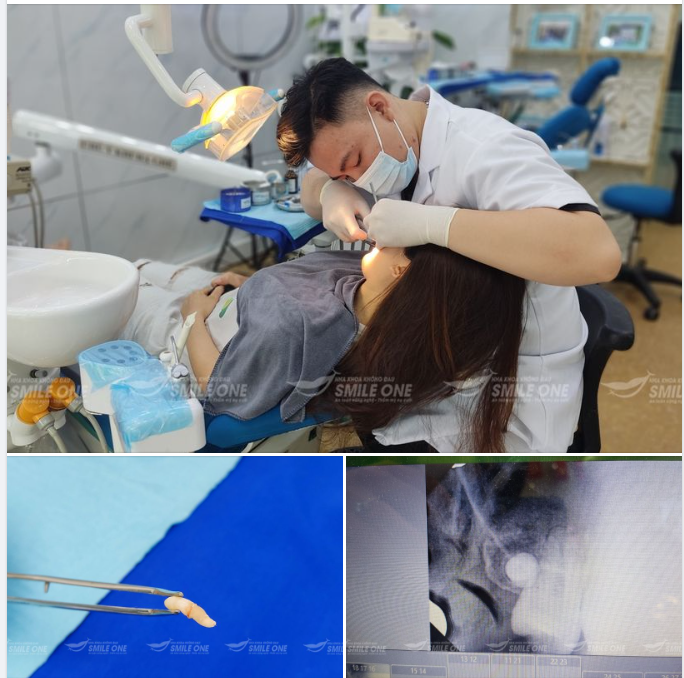 Răng số 9, có thật hay không?