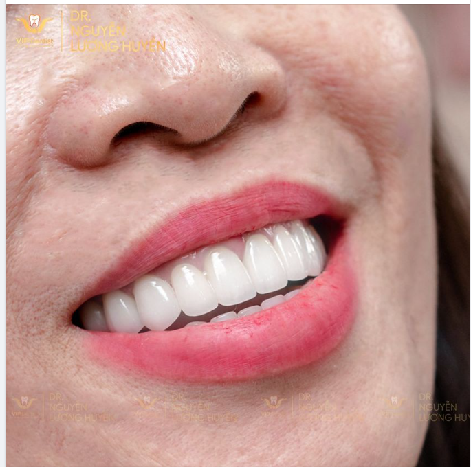 RĂNG SỨ VIP DENTIST - GIỮ THANH XUÂN MÃI MÃI BÊN BẠN