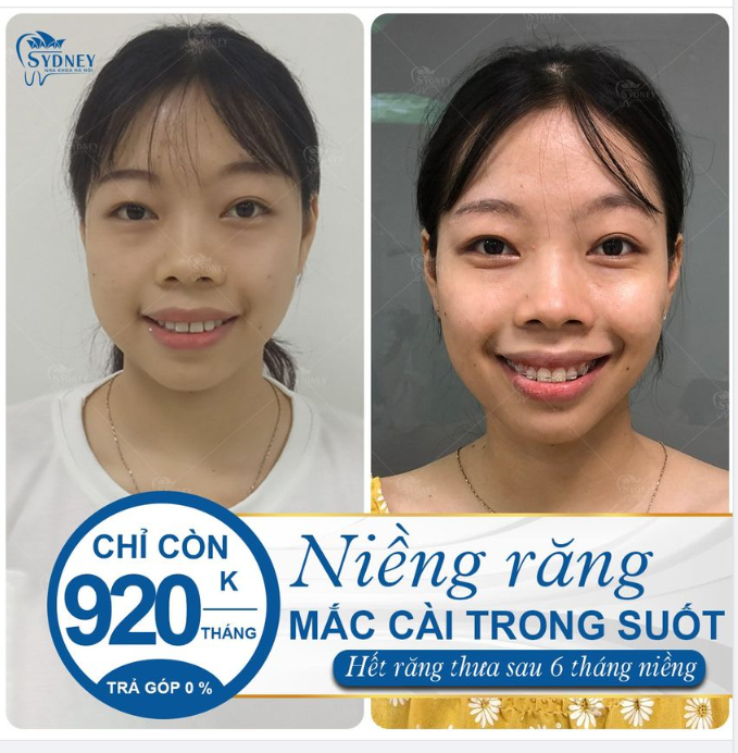 RĂNG THƯA CÓ CẦN NIỀNG RĂNG KHÔNG 