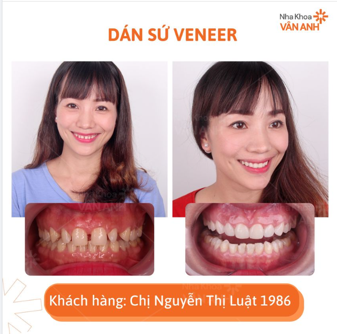 RĂNG THƯA ĐÃ KHIẾN CHỊ LUẬT MẤT ĐI VẺ ĐẸP VỐN CÓ