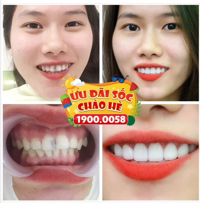 RĂNG TRẮNG SÁNG ĐÁNH SON GÌ CŨNG XINH - CHỈ TỪ 1,5TR/RĂNG