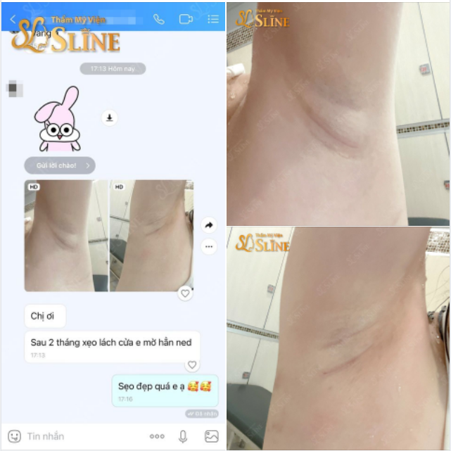 Rất nhiều các bạn quan tâm tới vết Sẹo sau khi nâng ngực sẽ như thế nào đúng không
