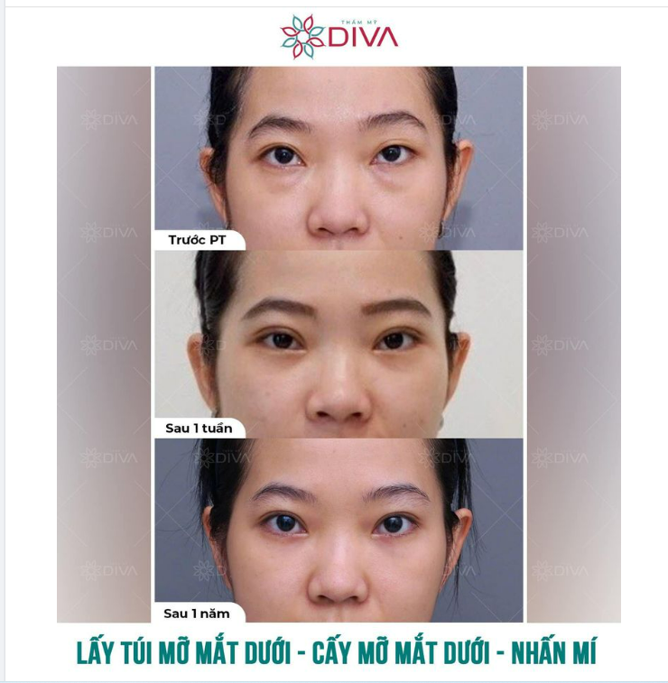 SAU 1 NĂM NHẤN MÍ, LẤY TÚI MỠ MẮT, CẤY MỠ MÍ MẮT KẾT QUẢ RA SAO