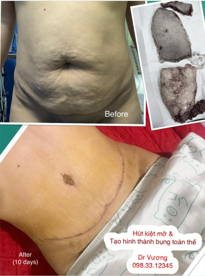 Sau 10 ngày là thon đẹp rồi, lấy lại V2 hơn thời thiếu nữ chứ nhỉ các bạn quan tâm