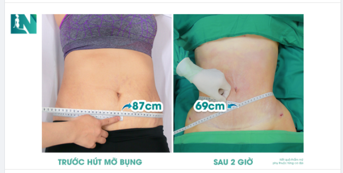 SAU 2 GIỜ - SỞ HỮU VÒNG EO ƯỚC MONG!