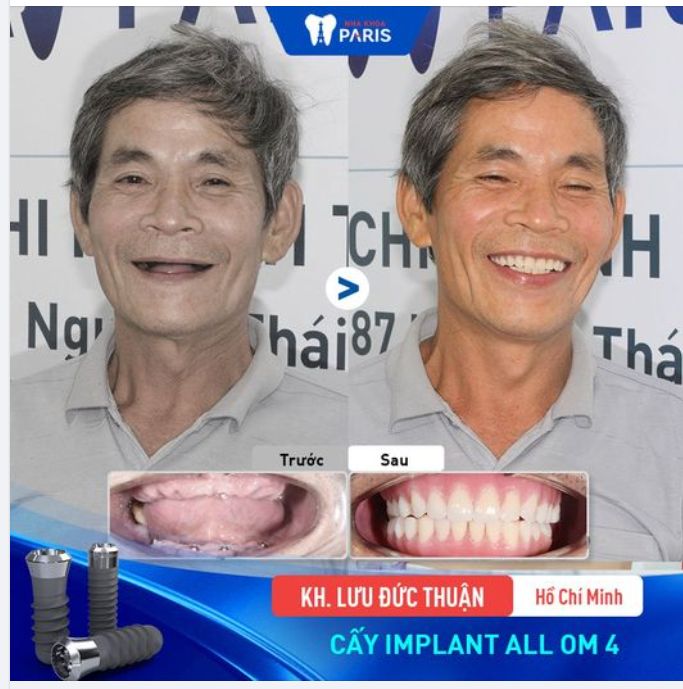 Sau khi được bác sĩ tư vấn trồng răng nguyên hàm bằng phương pháp implant all on 4, tôi thấy hợp lý và quyết định đầu tư cho mình một hàm răng mới.