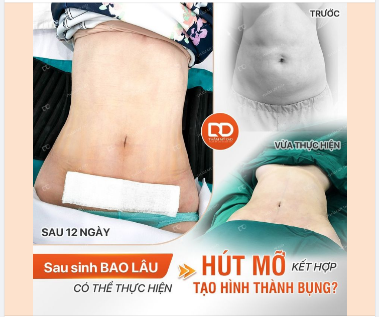 SAU SINH BAO LÂU THÌ CÓ THỂ THỰC HIỆN HÚT MỠ + CĂNG DA