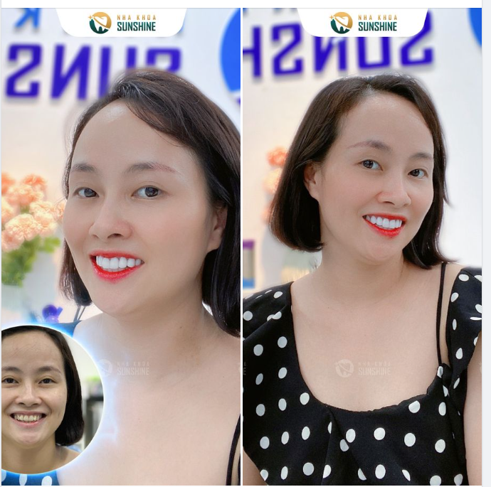 Sau thời gian tìm hiểu, Chị Vân Anh đã lựa chọn Sunshine để cải thiện nụ cười.