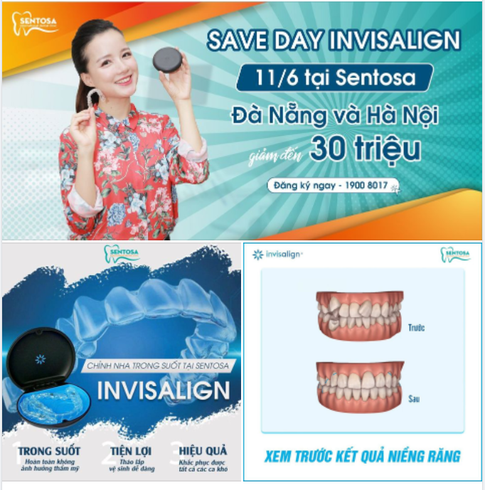SAVE DAY INVISALIGN - GIẢM NGAY 30 TRIỆU