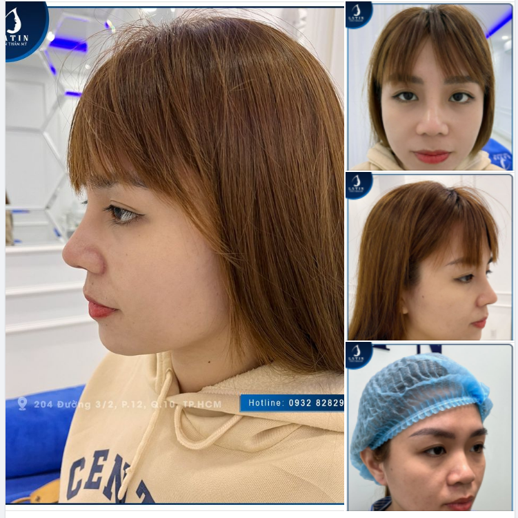 Siêu phẩm mũi cấu trúc sau 10 ngày