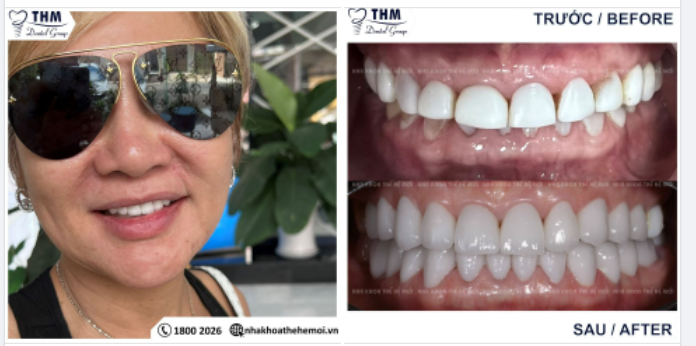 SỞ HỮU 24 RĂNG SỨ - MẶT SÁN SỨ VENEER CHỈ VỚI 3 NGÀY