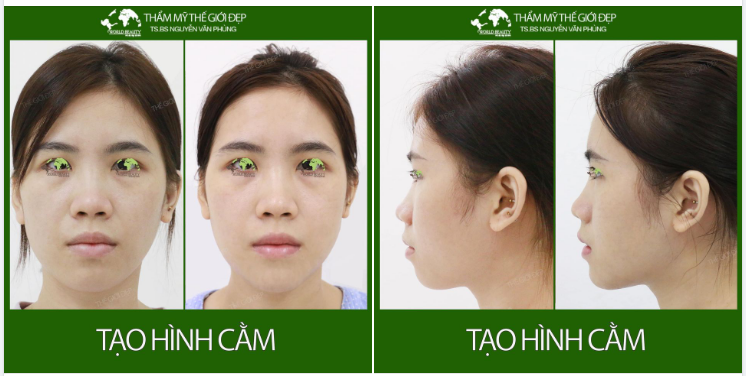 SỞ HỮU KHUÔN MẶT CÂN ĐỐI, CHUẨN TỶ LỆ VÀNG BẰNG GIẢI PHÁP TẠO HÌNH CẰM HIỆU QUẢ RA SAO