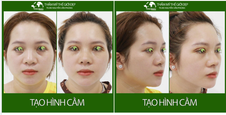 Sở hữu nét đẹp khuôn mặt thanh tú, sang trọng và dài lâu chỉ với phẫu thuật tạo hình cằm Surgiform