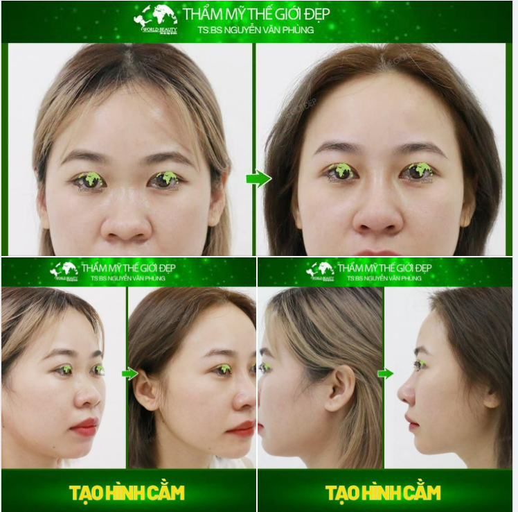 Sở hữu nhan sắc xinh xắn hơn với phẫu thuật tạo hình cằm bằng sụn sinh học Surgiform