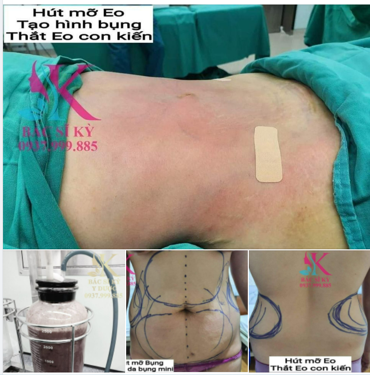 Sở hữu V2 thon gọn thanh mảnh, chị khách giờ đây đã có thể tự tin thả dáng, khoe thân hình gợi cảm nóng bỏng