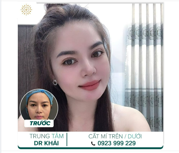 So sánh nếp mí sau 2 tuần của một khách hàng trung tâm bs Đỗ Quang Khải