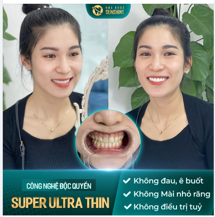 Sứ cao cấp chính hãng 100% có độ bền gấp 5-7 lần răng thật