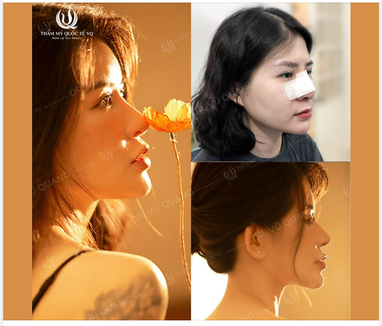 Sửa dáng mũi - Đổi cuộc đời