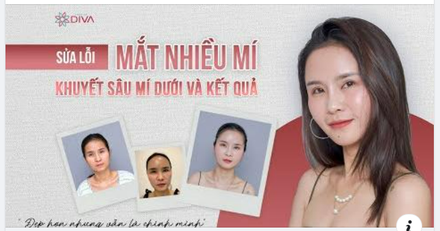 SỬA LỖI THẨM MỸ MẮT NHIỀU MÍ, SẸO NẾP MÍ, KHUYẾT SÂU VÙNG MÍ DƯỚI VÀ KẾT QUẢ