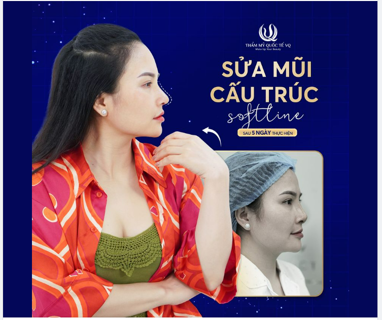 Sửa mũi cấu trúc Softline của Dr Vũ Quang sau 5 ngày sẽ như thế nào . Có sưng nề, bấm tím không