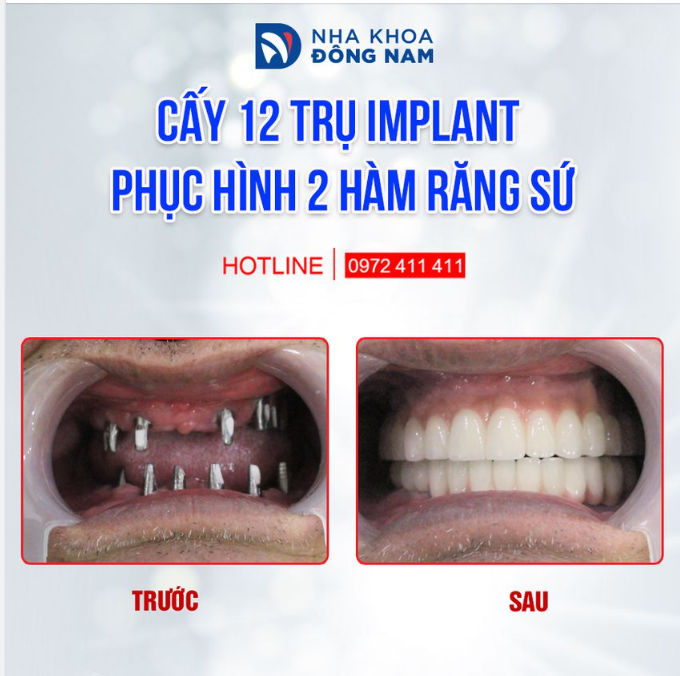SỨC KHỎE VÀ NIỀM TIN CẦN ĐƯỢC ĐẶT ĐÚNG NƠI MANG LẠI GIÁ TRỊ TƯƠNG XỨNG KHI CẤY IMPLANT TOÀN HÀM