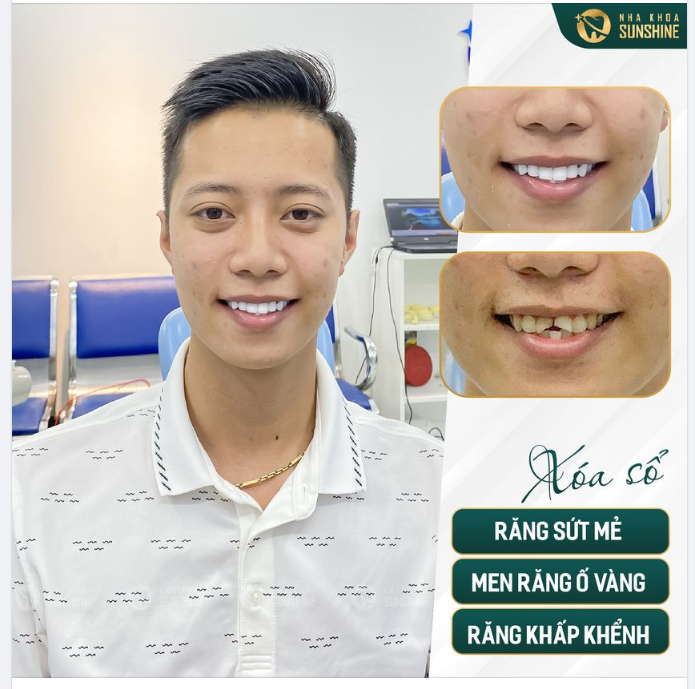 Sứt mẻ răng cửa mảnh lớn, phương pháp trám răng không mang lại hiệu quả, không thể khiến răng trở lại hình dáng ban đầu