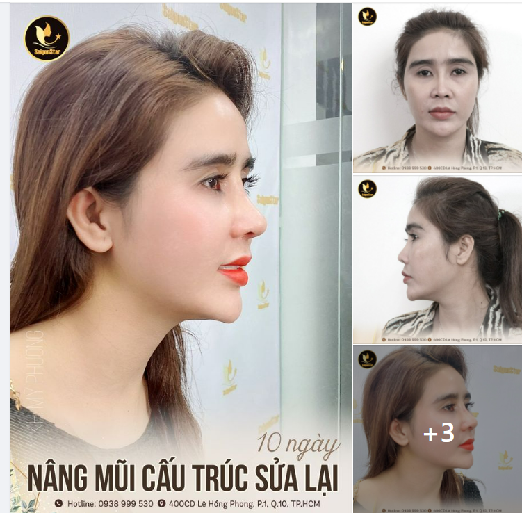 TÁI KHÁM 10 NGÀY NÂNG MŨI CẤU TRÚC SỬA LẠI ĐẸP MỘT CÁCH AN TOÀN