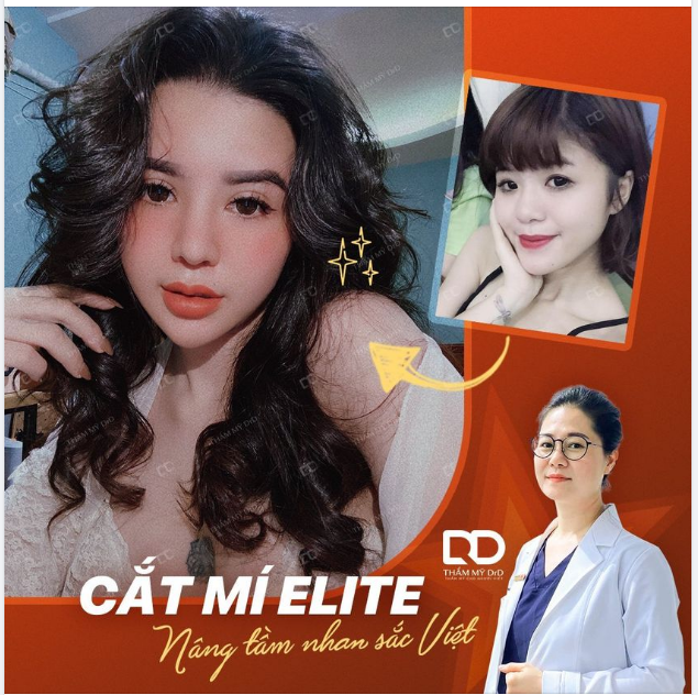 Tái khám 4 năm sau cắt mí Elite Eyes, nàng khách trẻ vẫn cực kỳ ưng ý...