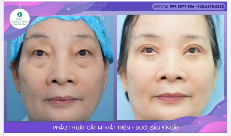 Tại sao người già nên cắt mí mắt