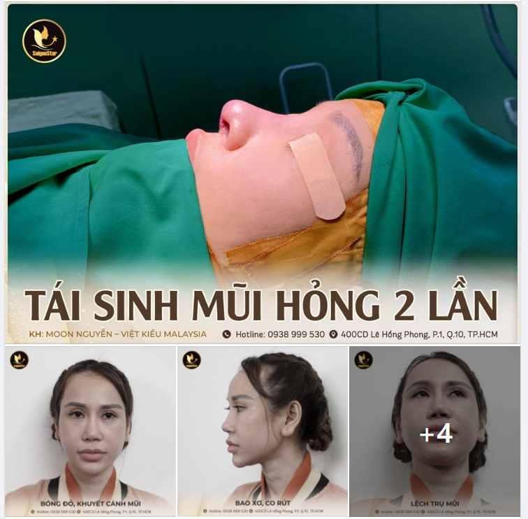 TÁI SINH MŨI HỎNG 2 LẦN HỒI KẾT CHUYẾN BAY TỪ MALAYSIA VỀ VIỆT NAM
