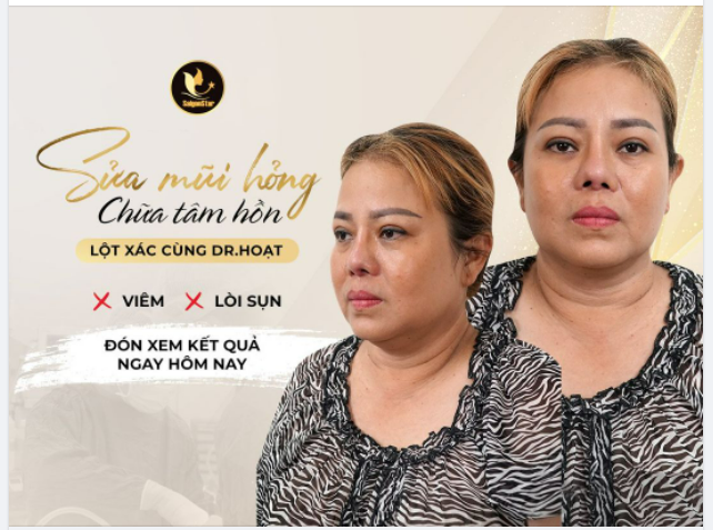 TÁI SINH MŨI HỎNG CÙNG DR.HOẠT – CHỜ ĐỢI ĐIỀU KỲ DIỆU SUẤT TÀI TRỢ 100% SỬA MŨI HỎNG CHO NHÂN VẬT ĐẶNG KIM TUYẾT