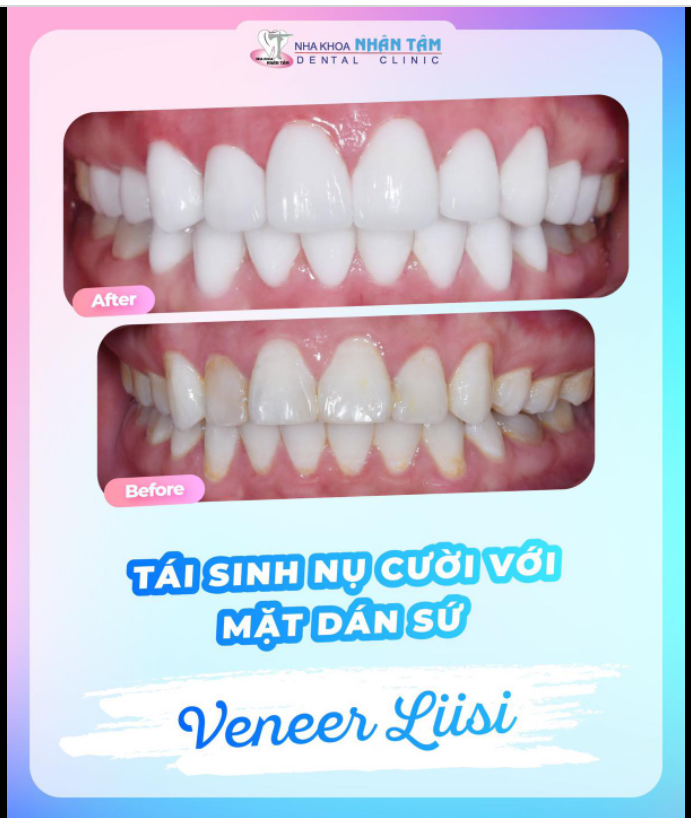 TÁI SINH NỤ CƯỜI VỚI VENEER – KỸ THUẬT HẠN CHẾ TỐI ĐA MÀI RĂNG