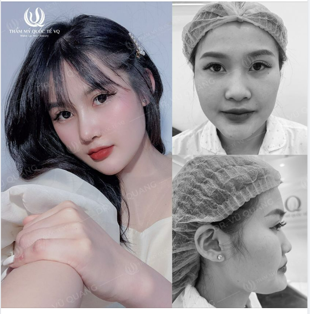 Tặng 10 chị em mũi tẹt, mũi bè - Nâng mũi cấu trúc Softline chỉ còn 30tr