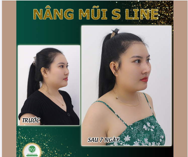 TẶNG 10 SUẤT NÂNG MŨI S LINE GIÁ CHỈ 35TRIỆU