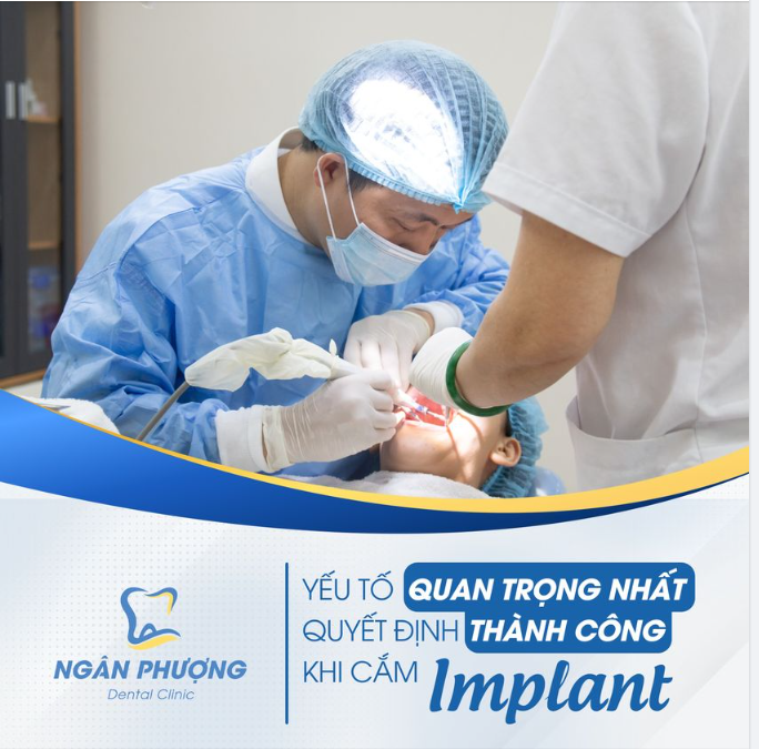 Tay nghề bác sĩ - Yếu tố tiên quyết dẫn đến thành công của ca trồng răng Implant