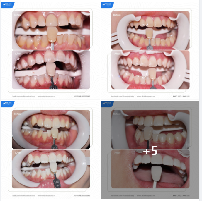 TẨY TRẮNG RĂNG -  TRƯỚC - SAU ĐIỀU TRỊ
