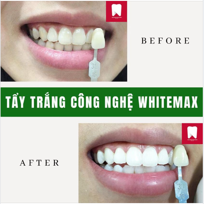 TẨY TRẮNG RĂNG WHITEMAX - TIẾT KIỆM, NHANH CHÓNG, RĂNG SÁNG BẬT TONE