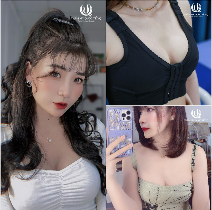 Teo lé.p  đồng bằng sa trễ... Bẩm sinh hay Sau sinh