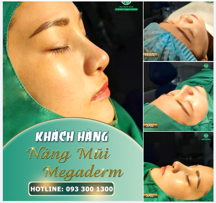 THẢ NHẸ MỘT DÁNG MŨI SIÊU XINH SAU PHẪU THUẬT