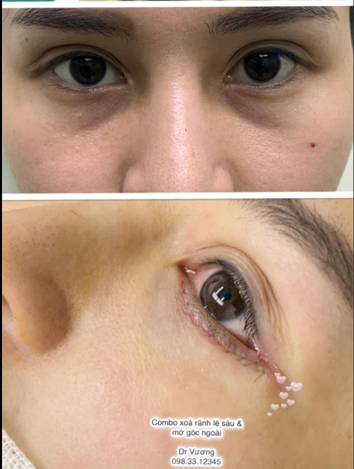 Thẩm mỹ mắt đi sâu tới từng chi tiết chỉ có ở Dr Vương !