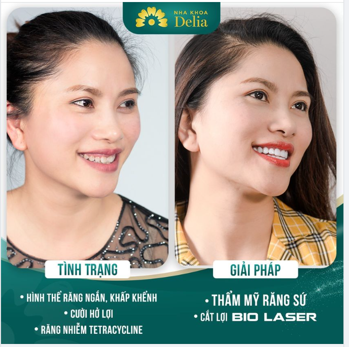 Thẩm mỹ răng sứ - Kiến tạo nụ cười theo nét riêng của bạn