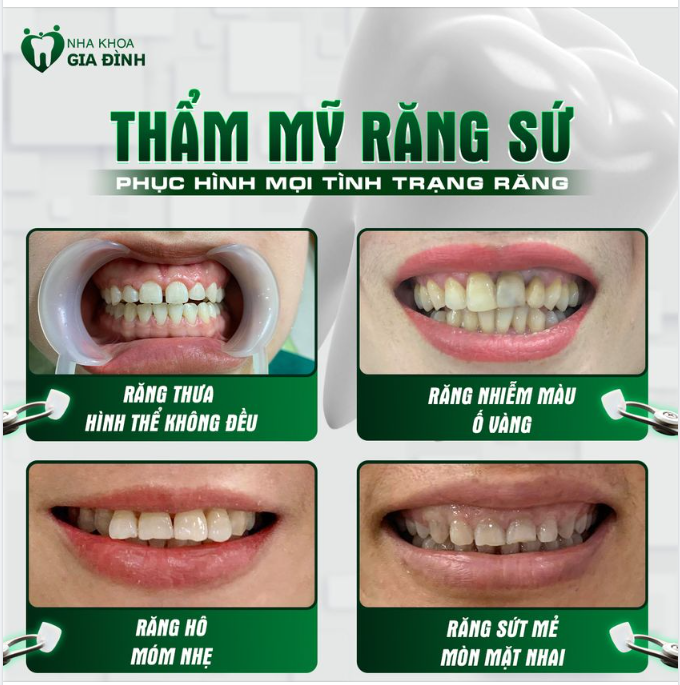 THẨM MỸ RĂNG SỨ - PHỤC HÌNH MỌI TÌNH TRẠNG RĂNG XẤU
