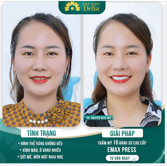 Thẩm mỹ răng sứ - tạm biệt "khấp khểnh" chỉ sau 02 lần hẹn
