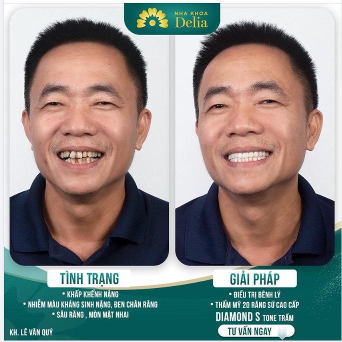 Thẩm mỹ răng sứ - Tìm lại sức khoẻ nụ cười