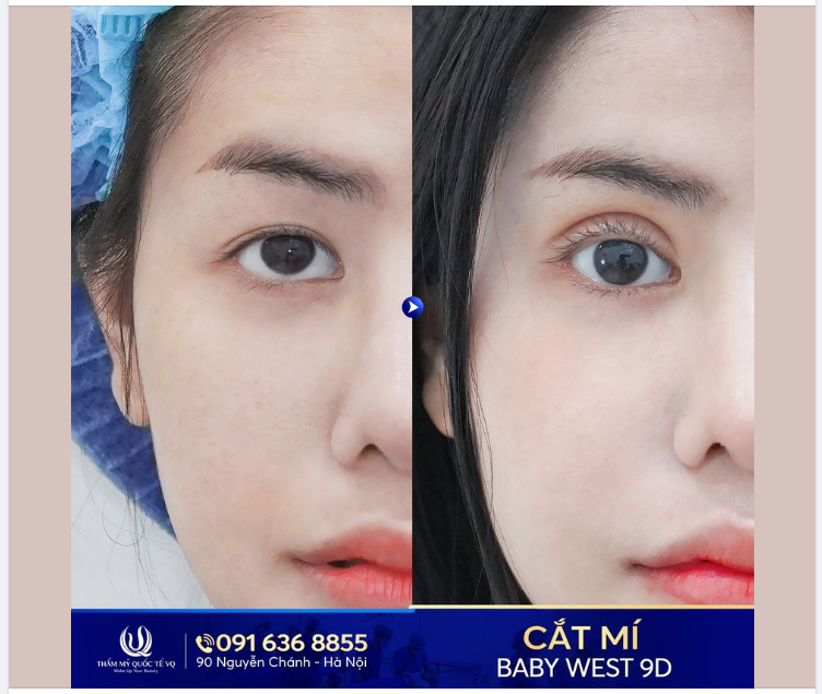 Thần thái rạng ngời với nếp mí mới