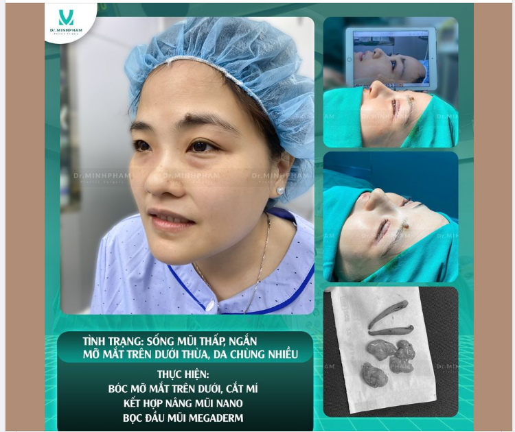 Thay đổi hoàn hảo nhờ combo Nâng mũi + Cắ.t mí