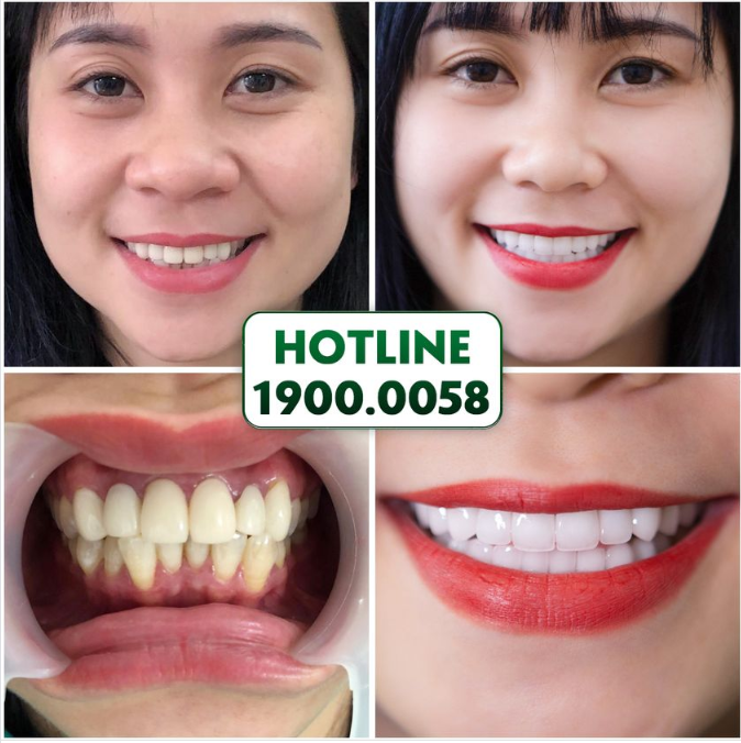 THAY RĂNG ĐỔI VẬN - ÔM TRỌN PHÚC QUÝ