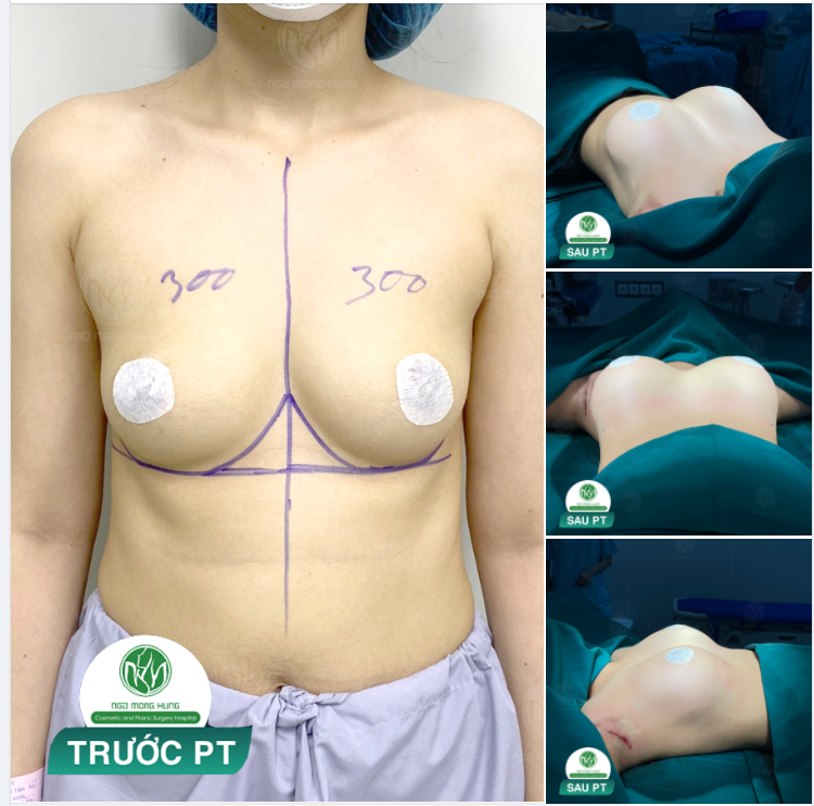 THÊM 1 KẾT QUẢ SAU NÂNG NGỰC ĐẶT TÚI